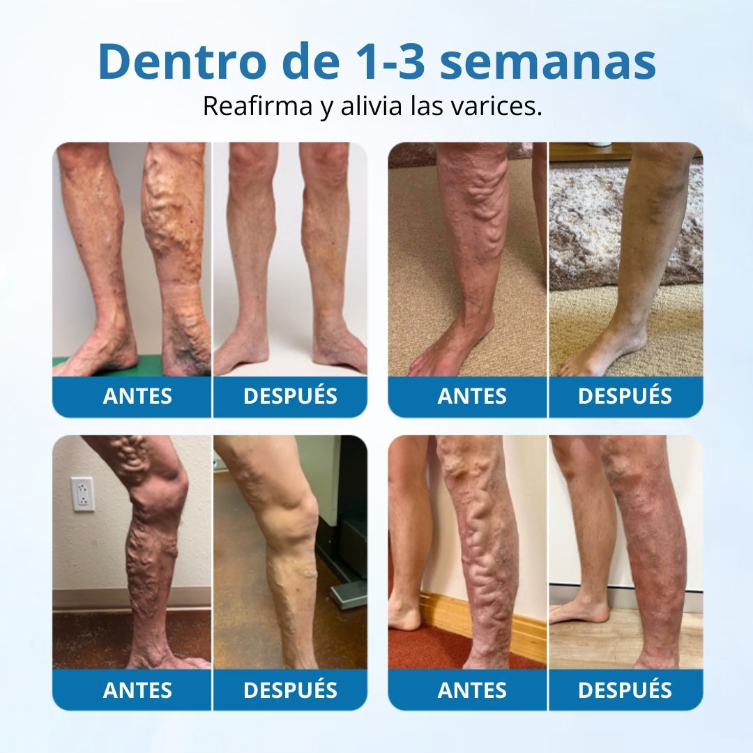 Timilk® VeinGuard Spray de Hierbas-✅ Clínicamente probado para eliminar las venas varicosas en solo 7 días.