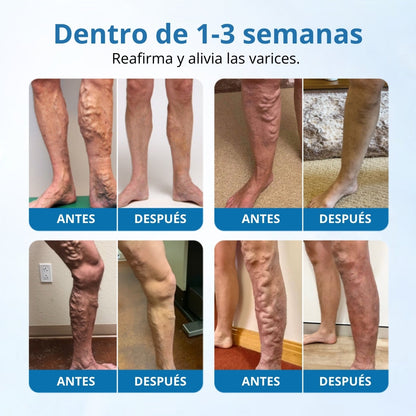 Timilk® VeinGuard Spray de Hierbas-✅ Clínicamente probado para eliminar las venas varicosas en solo 7 días.