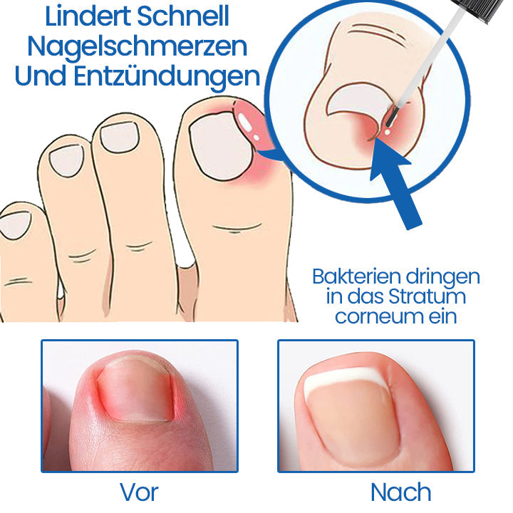 Ceoerty™ NailHeal: Kräuter-Nagelreparaturgel