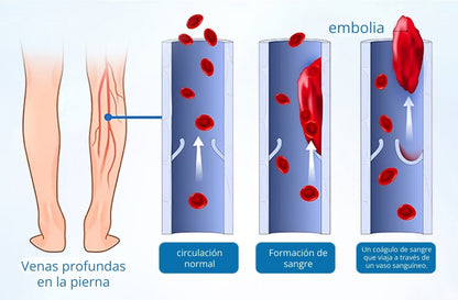 Timilk® VeinGuard Spray de Hierbas-✅ Clínicamente probado para eliminar las venas varicosas en solo 7 días.