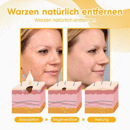 Ceoerty™ SpotErase Bienengift Maulwurf & Warze Entferner Creme