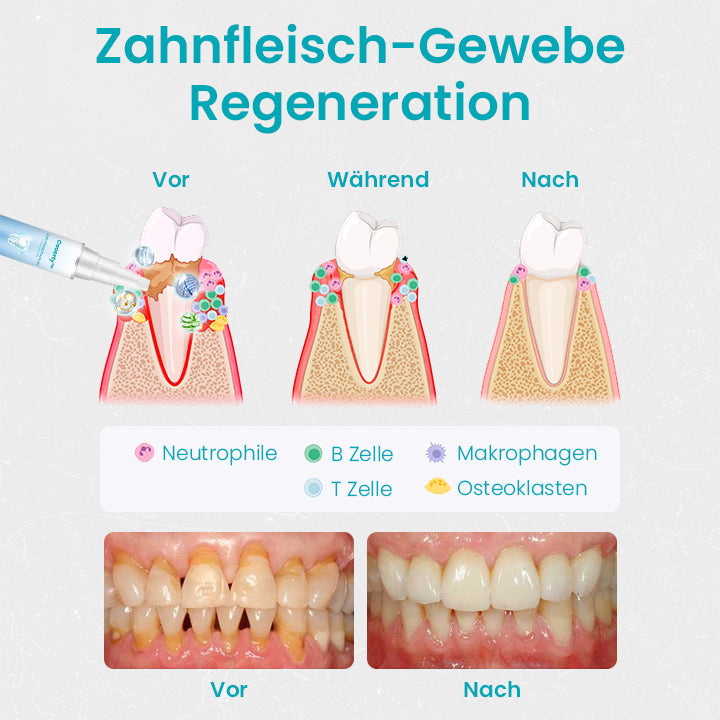 Ceoerty™ Zahnfleischschutz-Therapie-Gel