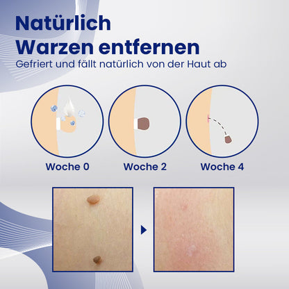 Ceoerty™ WartsErase Makel Hautentferner-Creme